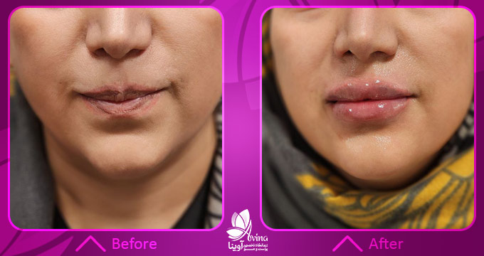 نمونه کار تزریق ژل لب در کلینیک آوینا