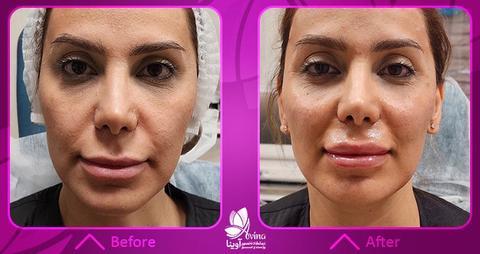 نمونه کار تزریق ژل لب در کلینیک آوینا