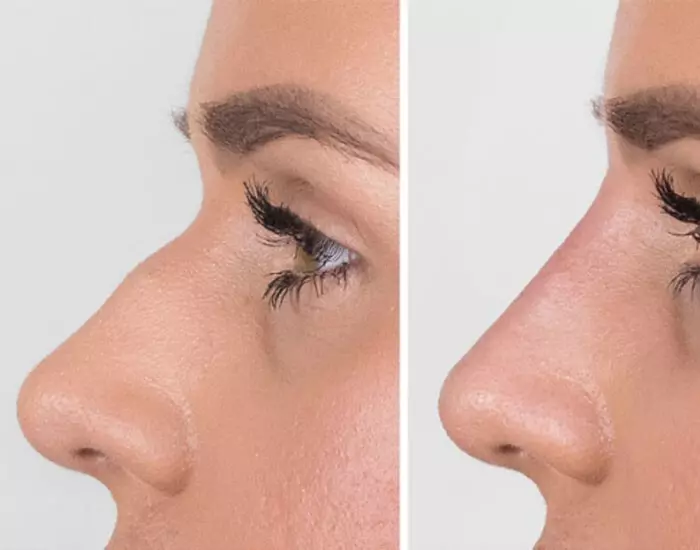 فواید مراجعه به بهترین مرکز فیلر بینی در گوهردشت