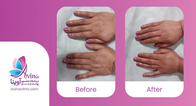 مراقبتهای قبل و بعد از تزریق چربی