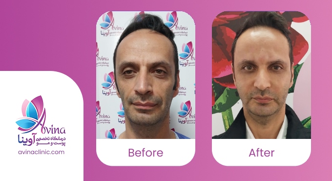 چرا تزریق چربی؟