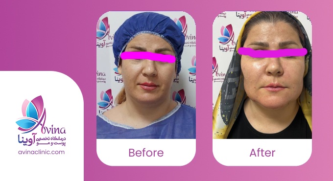 نمونه کار 2 تزریق چربی در کلینیک آوینا