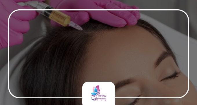 کاربردهای PRP برای درمان ریزش مو