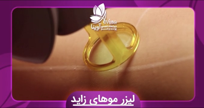 تفاوت لیزر موهای زائد مردان با زنان