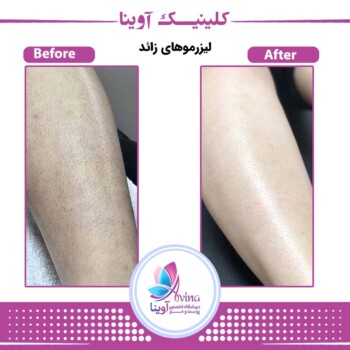 نمونه کار لیزر موهای زاعد در کلینیک آوینا