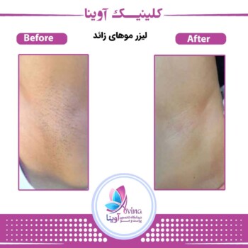 نمونه کار لیزر موهای زاعد در کلینیک آوینا