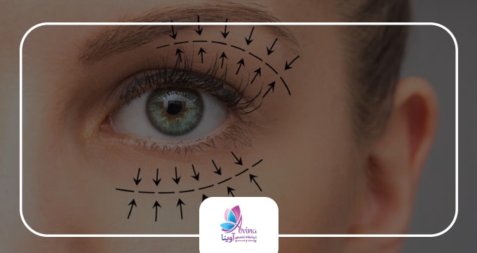 بلفاروپلاستی چیست؟