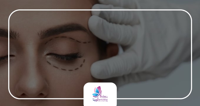 بلفاروپلاستی چیست؟