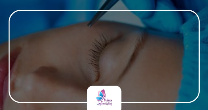 بلفاروپلاستی چیست؟