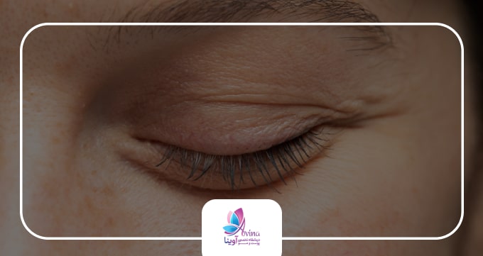 مزایای بلفاروپلاستی