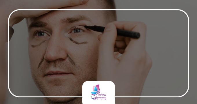 چه کسانی بهترین کاندید بلفاروپلاستی هستند؟