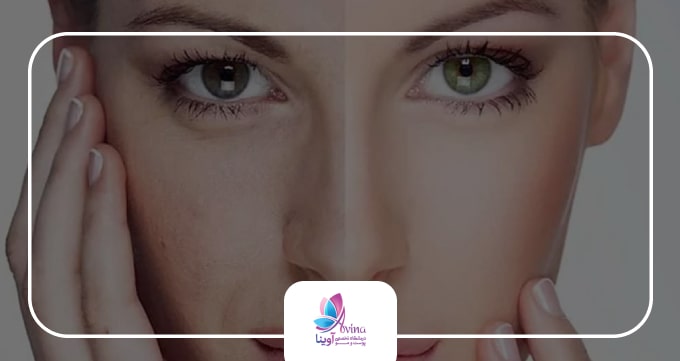 ۳. تزریق بوتاکس