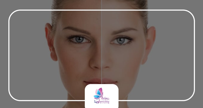 ۶. میکرونیدلینگ