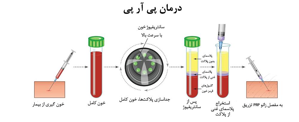 مراحل تزریق PRP در کرج