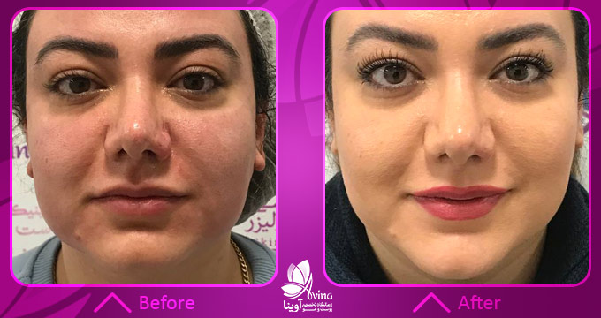 مزایای تزریق PRP نسبت به سایر روشها