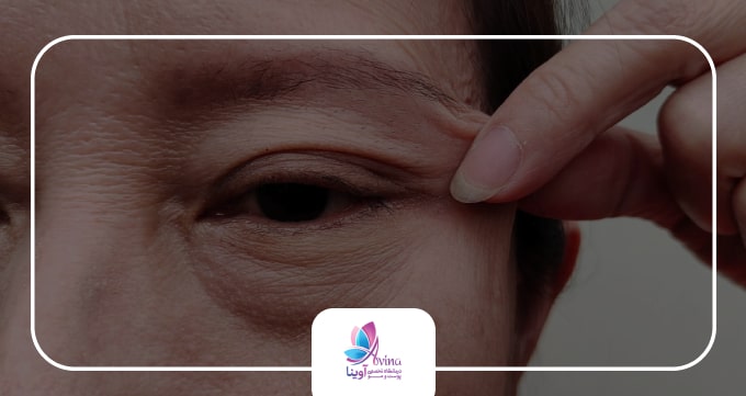 بلفاروپلاستی چیست؟