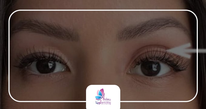 بلفاروپلاستی چیست و چه کاربردی دارد؟