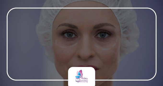 عمل بلفاروپلاستی چیست؟