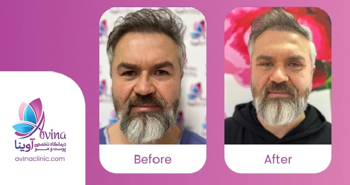 روشهای درمان گوشت اضافه بعد از بلفاروپلاستی