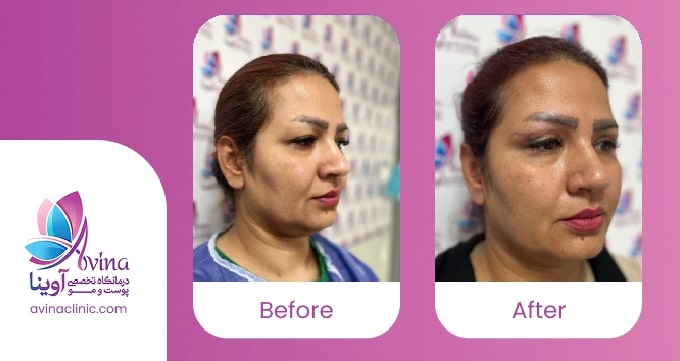 کلینیک آوینا: تجربه و تخصص در اصلاح باز ماندن چشم