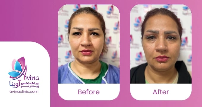 علائم و نشانههای گوشت اضافه بعد از بلفاروپلاستی