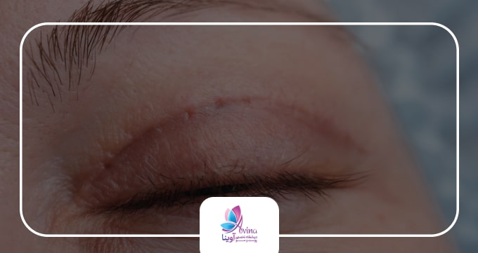 بلفاروپلاستی چیست؟