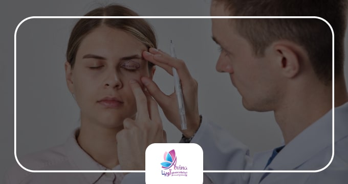 بلفاروپلاستی چیست و چرا انجام میشود؟