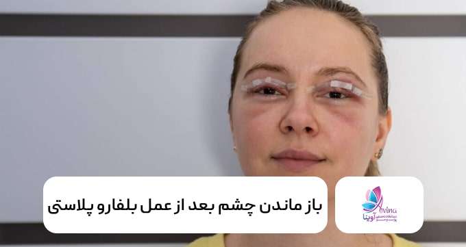 باز ماندن چشم بعد از عمل بلفارو پلاستی