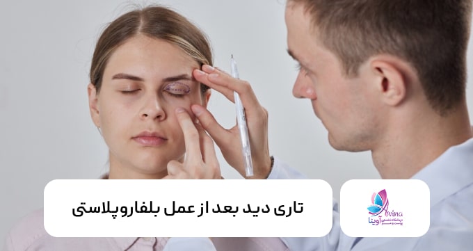 تاری دید بعد از عمل بلفاروپلاستی