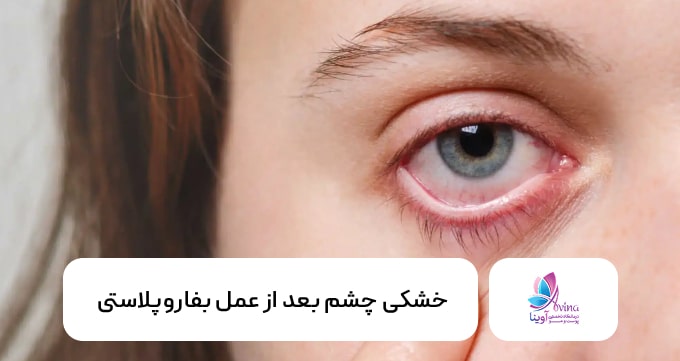 خشکی چشم بعد از عمل بفاروپلاستی