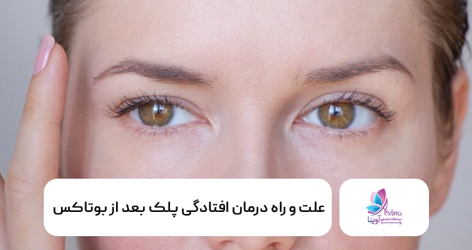 علت و راه درمان افتادگی پلک بعد از بوتاکس
