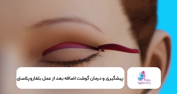 پیشگیری و درمان گوشت اضافه بعد از عمل بلفاروپلاستی