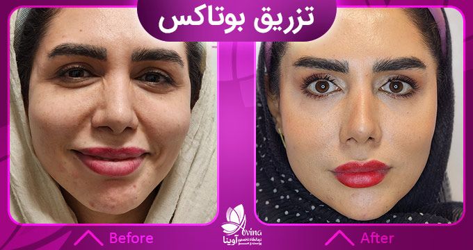 نمونه کار بوتاکس در کلینیک آوینا