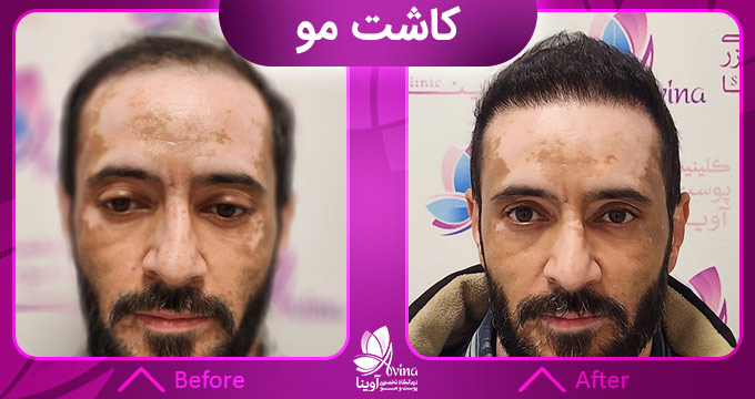 نمونه کار کاشت مو در کلینیک آوینا