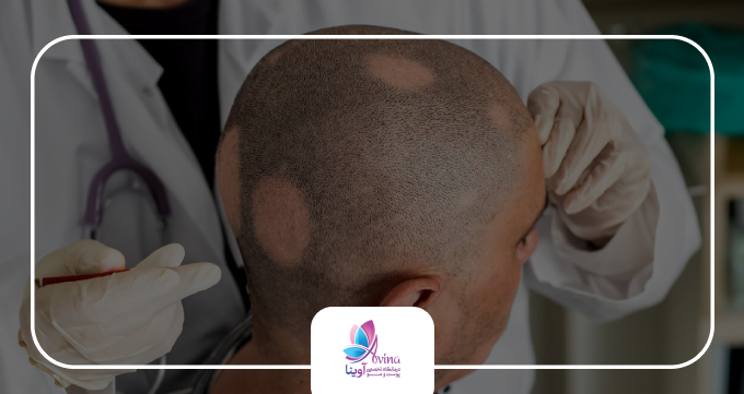 راهکارهای درمانی آلوپسی