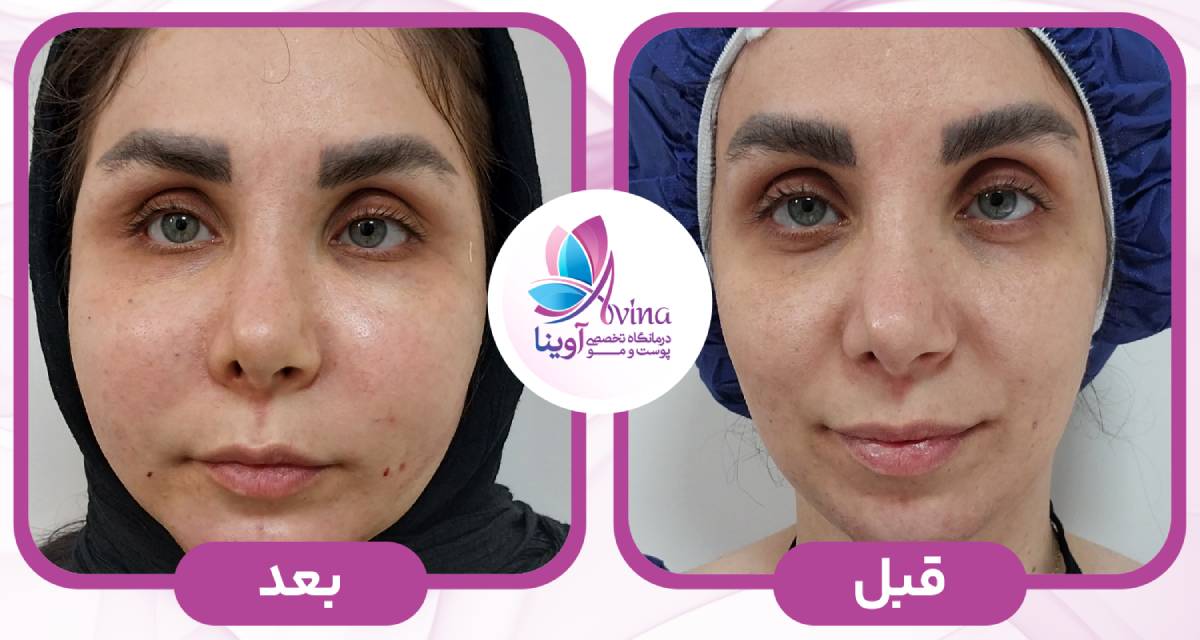 چرا کلینیک آوینا بهترین انتخاب برای تزریق چربی است؟