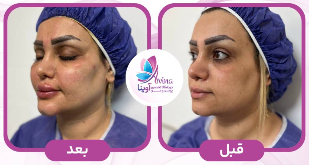 کاربردهای تزریق چربی