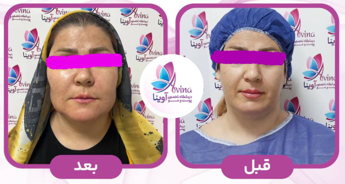 ترکیب تزریق چربی با دیگر روشها
