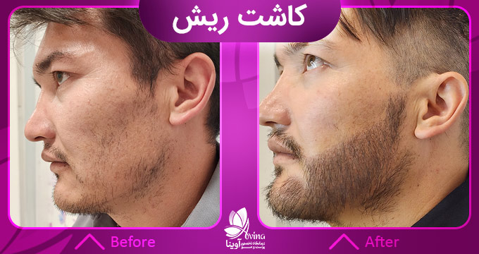 تفاوت کاشت ریش و روشهای دیگر