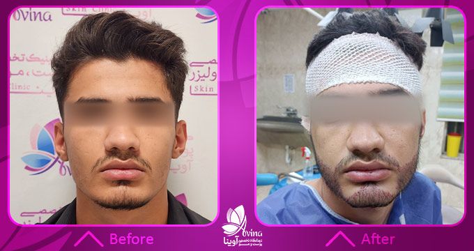 مزایای کاشت ریش در کلینیک آوینا