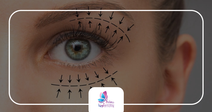 چرا بلفاروپلاستی به یک دغدغه تبدیل میشود؟