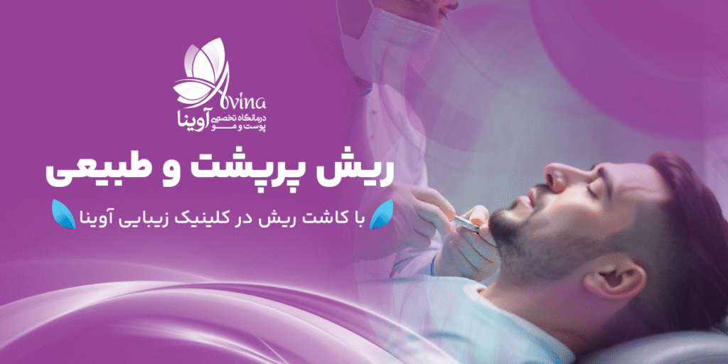 ریش پر پشت طبیعی در کلینیک آوینا