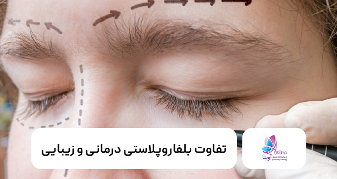تفاوت بلفاروپلاستی درمانی و زیبایی