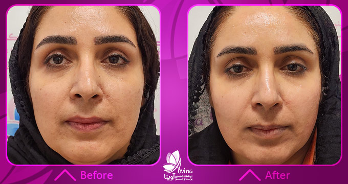 نمونه-کار-هایفوتراپی-در-کلینیک-آوینا