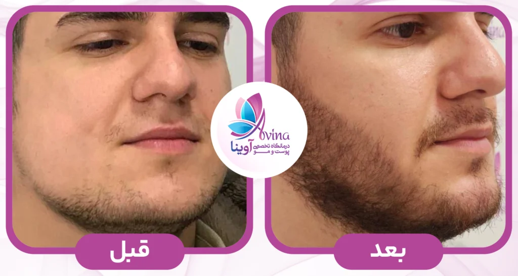 کاشت-ریش-آوینا