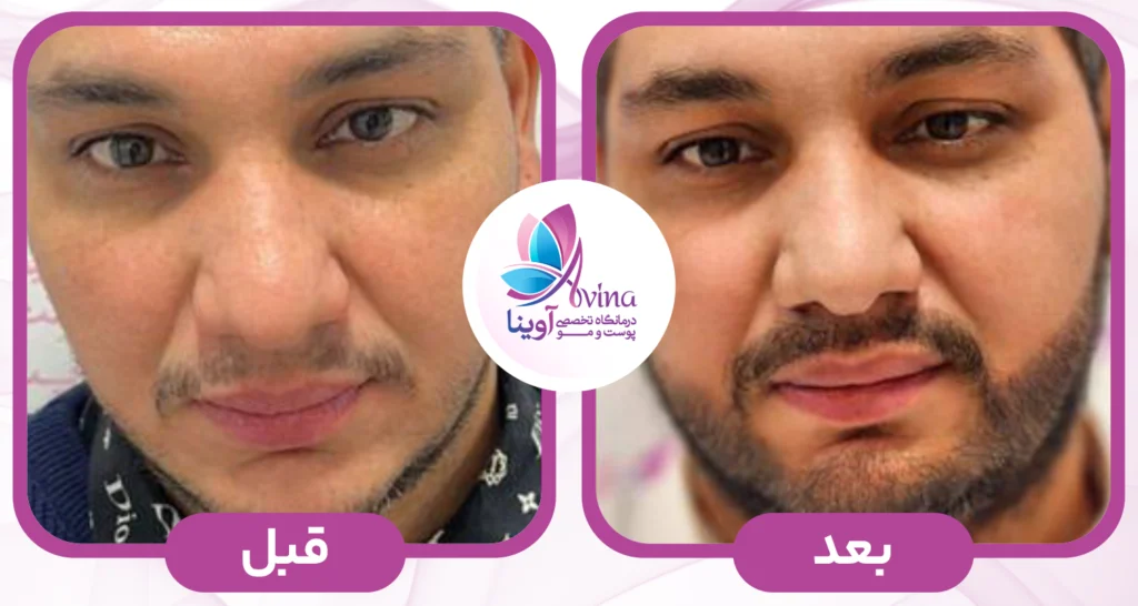 تفاوت کاشت ریش و روشهای دیگر