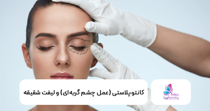 کانتوپلاستی (عمل چشم گربهای) و لیفت شقیقه