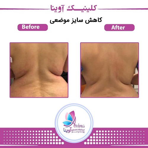 نمونه کار لاغری در کلینیک آوینا