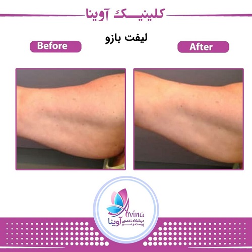 نمونه کار لاغری در کلینیک آوینا