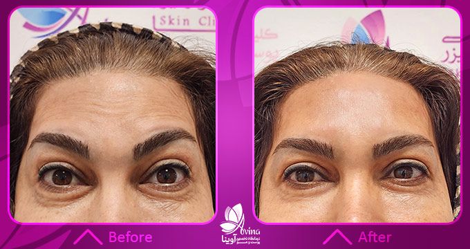نمونه کار بوتاکس در کلینیک آوینا